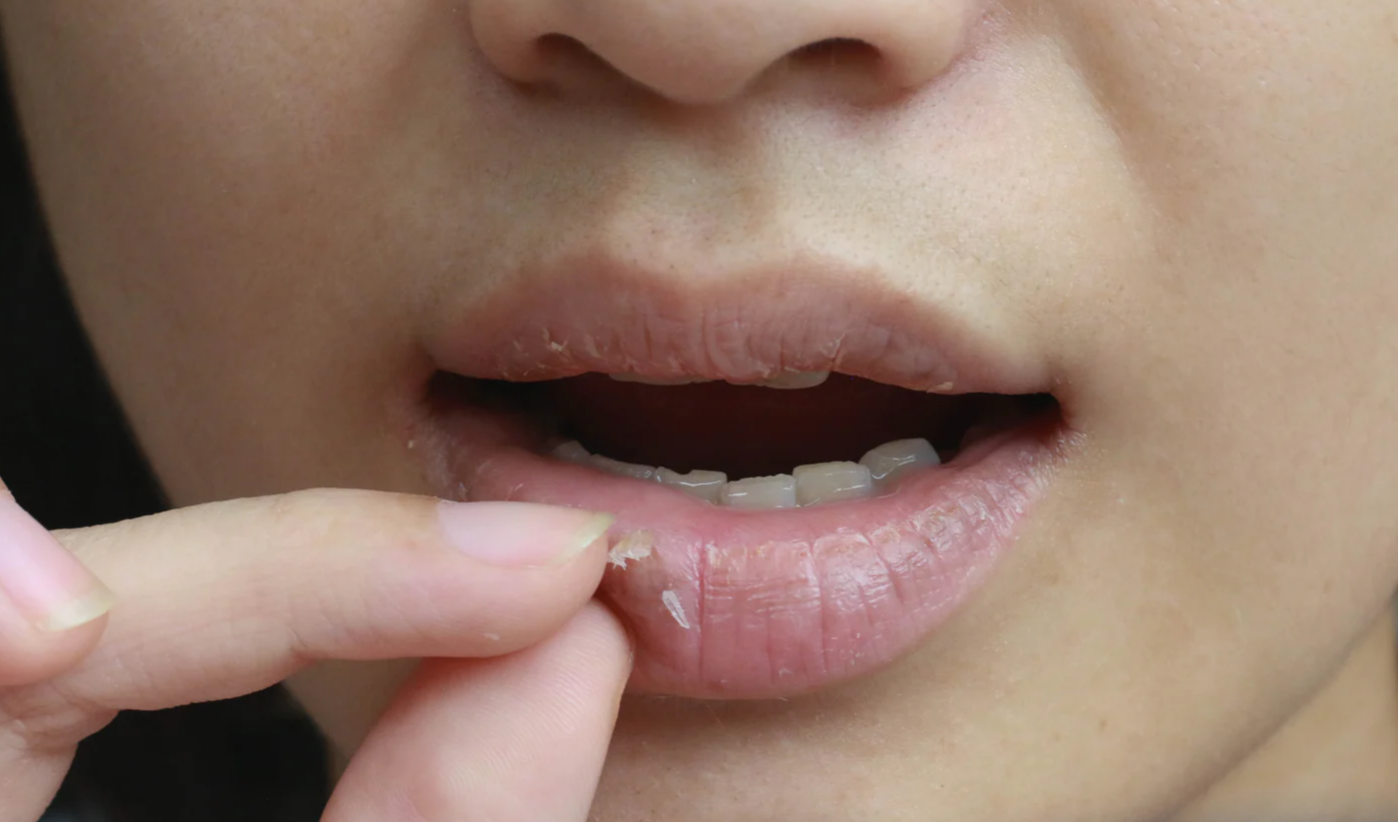 Vitamin Deficiency Causes Chapped Lips in Winter : చలికాలంలో పొడిబారే పెదవులు: వాతావరణమే కాదు, కారణం B12 లోపం కూడా