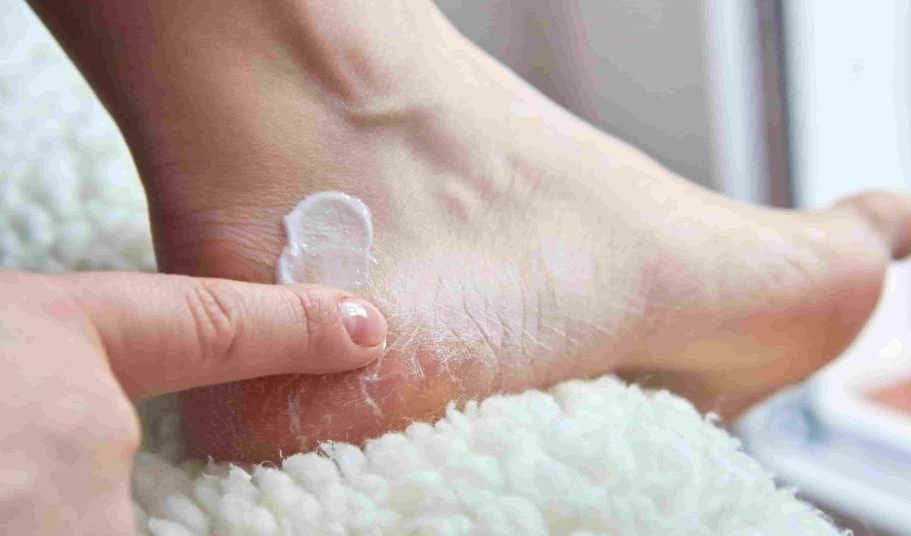 Cracked Heels : చలికాలంలో పాదాల పగుళ్లు – కారణాలు, నివారణ మార్గాలు