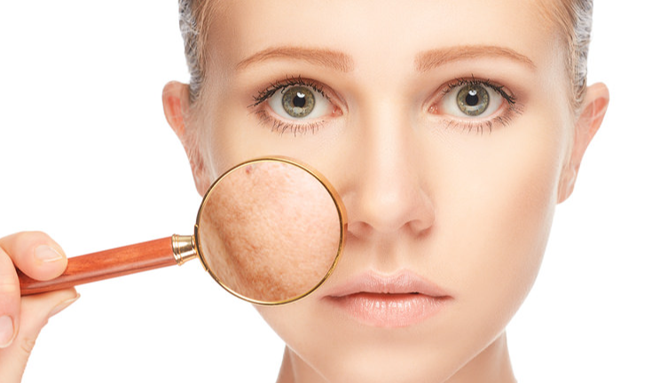 Acne And Pigmentation  : మొటిమలు, పిగ్మెంటేషన్, నల్ల మచ్చలతో విసిగిపోయారా